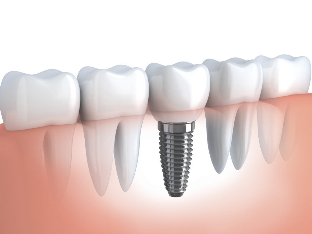 Frequently Asked Questions About Dental Implants