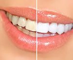 Top Tips to Prolong the Effects of Teeth Whitening